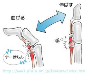 腱鞘炎