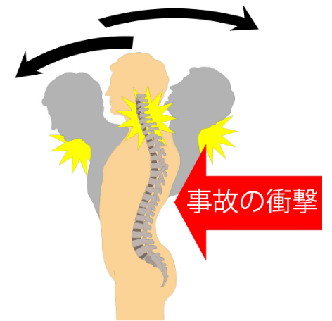 脊椎のズレや歪みは湿布や注射では治りませんし筋肉の損傷も湿布だけでは改善しません。